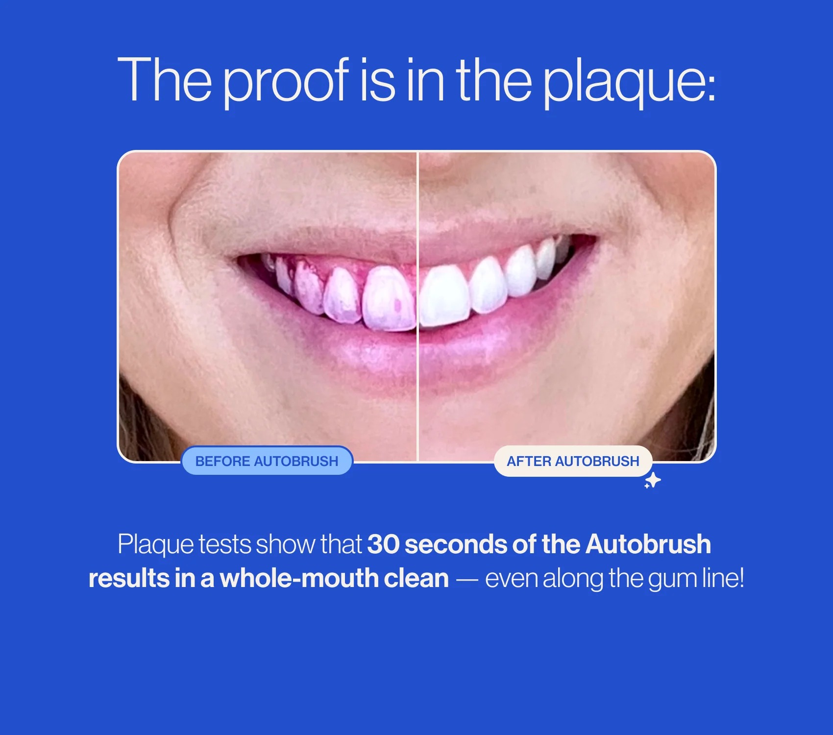 Before and after — 30 seconds of 360° Sonic Electric Toothbrush delivers a whole-mouth clean