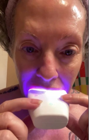 Blue-light whitening in action